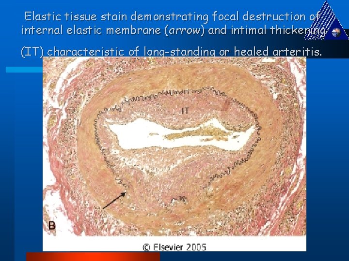 Elastic tissue stain demonstrating focal destruction of internal elastic membrane (arrow) and intimal thickening