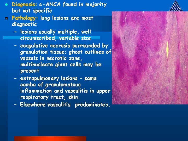 l Diagnosis: c-ANCA found in majority but not specific Pathology: lung lesions are most