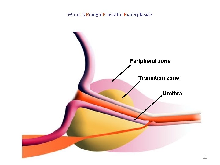 What is Benign Prostatic Hyperplasia? Peripheral zone Transition zone Urethra 11 