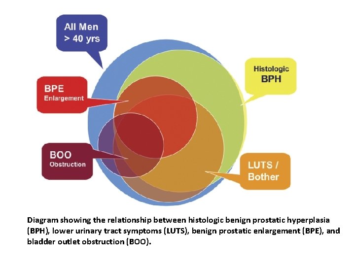 Diagram showing the relationship between histologic benign prostatic hyperplasia (BPH), lower urinary tract symptoms