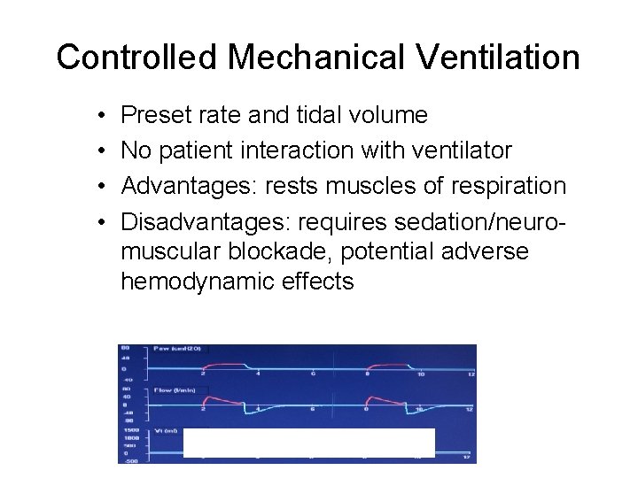 Controlled Mechanical Ventilation • • Preset rate and tidal volume No patient interaction with