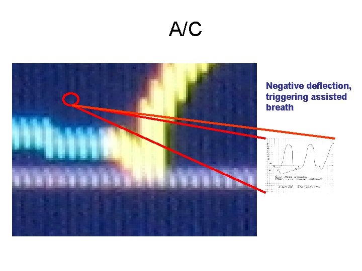 A/C Negative deflection, triggering assisted breath 