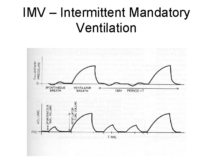 IMV – Intermittent Mandatory Ventilation 