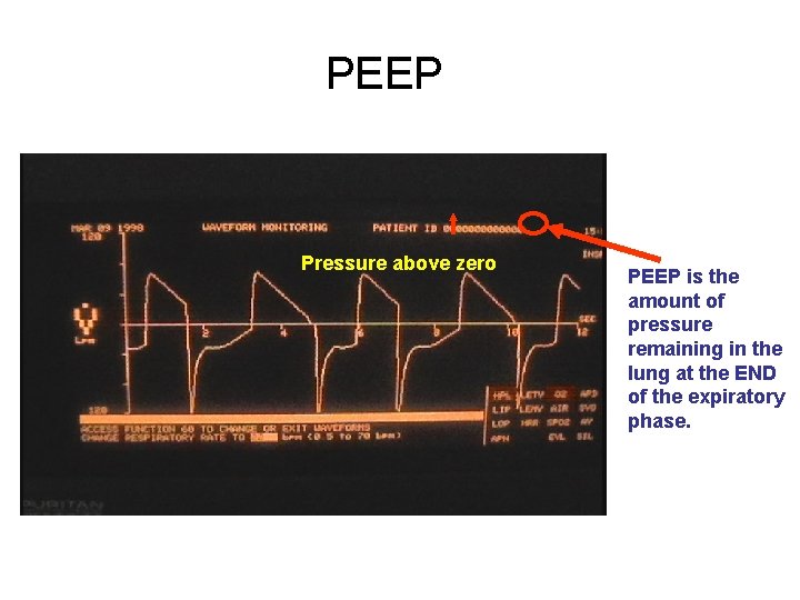 PEEP Pressure above zero PEEP is the amount of pressure remaining in the lung