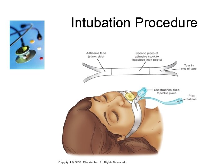 Intubation Procedure 