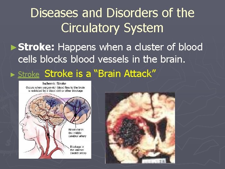 Diseases and Disorders of the Circulatory System ► Stroke: Happens when a cluster of