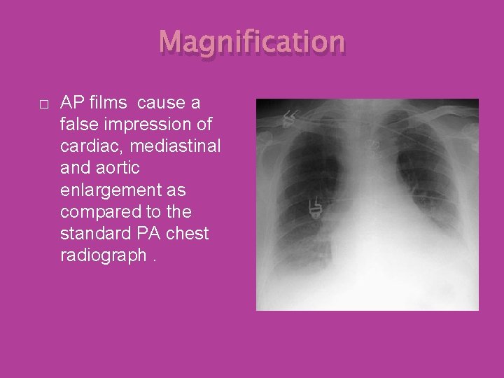 Magnification � AP films cause a false impression of cardiac, mediastinal and aortic enlargement