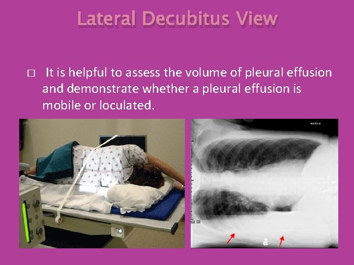 Lateral Decubitus View � It is helpful to assess the volume of pleural effusion