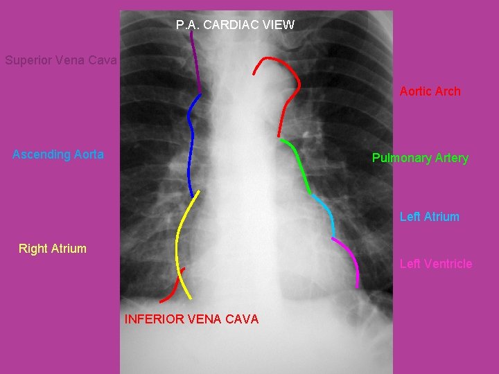 P. A. CARDIAC VIEW Superior Vena Cava Aortic Arch Ascending Aorta Pulmonary Artery Left