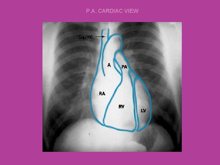 P. A. CARDIAC VIEW 