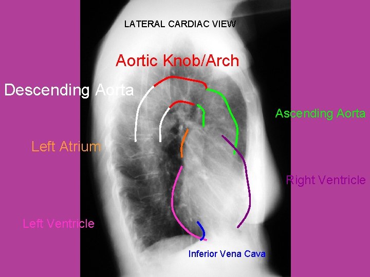 LATERAL CARDIAC VIEW Aortic Knob/Arch Descending Aorta Ascending Aorta Left Atrium Right Ventricle Left