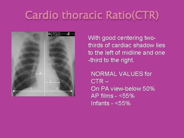 Cardio thoracic Ratio(CTR) With good centering twothirds of cardiac shadow lies to the left