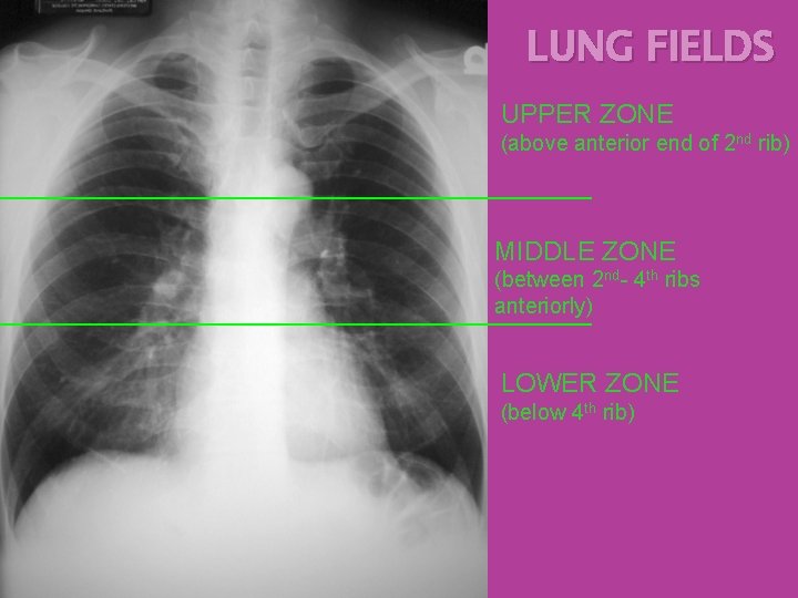 LUNG FIELDS UPPER ZONE (above anterior end of 2 nd rib) MIDDLE ZONE (between