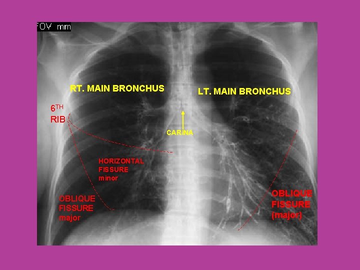 RT. MAIN BRONCHUS LT. MAIN BRONCHUS 6 TH RIB CARINA HORIZONTAL FISSURE minor OBLIQUE