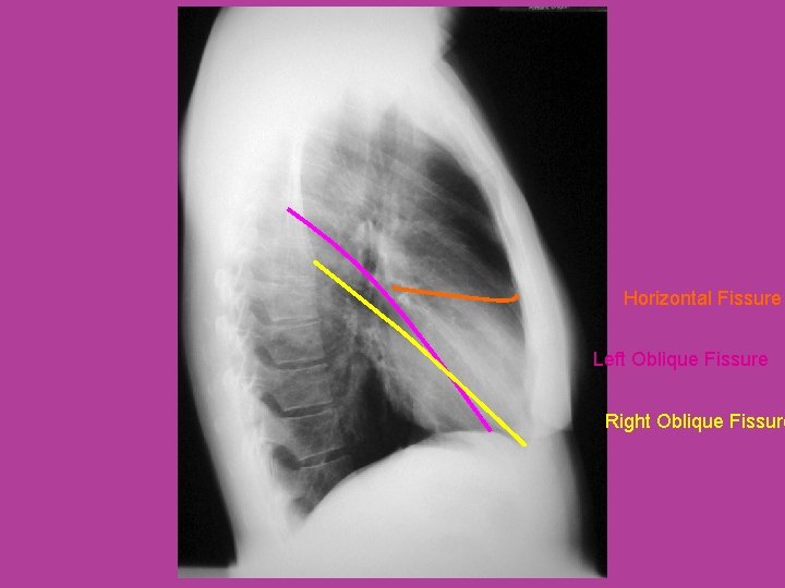 Horizontal Fissure Left Oblique Fissure Right Oblique Fissure 