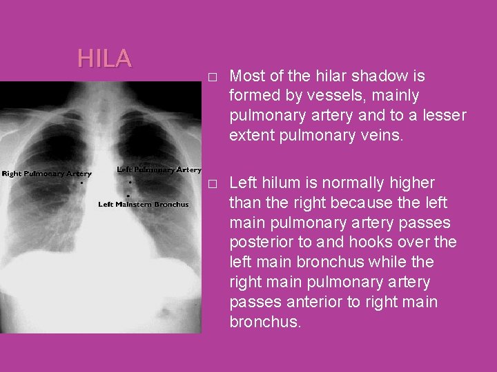 HILA � Most of the hilar shadow is formed by vessels, mainly pulmonary artery