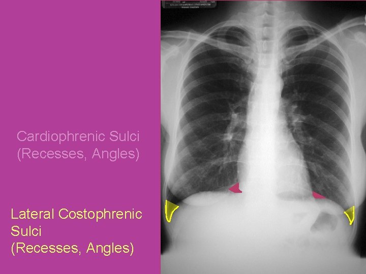 Cardiophrenic Sulci (Recesses, Angles) Lateral Costophrenic Sulci (Recesses, Angles) 