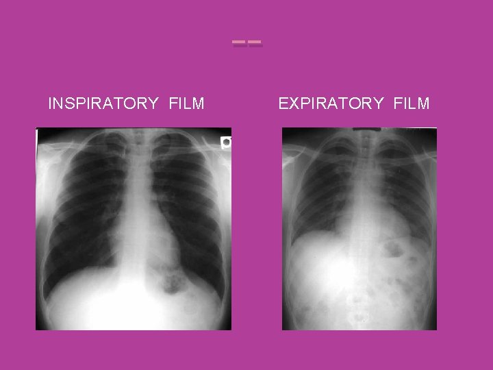 -INSPIRATORY FILM EXPIRATORY FILM 