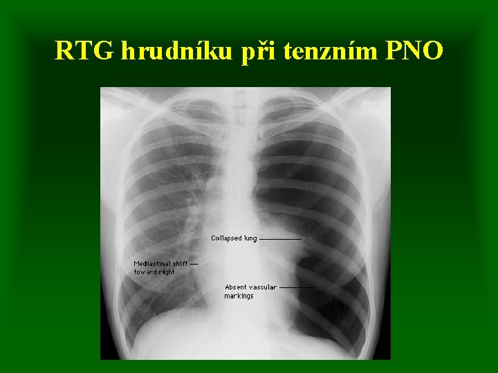 RTG hrudníku při tenzním PNO 