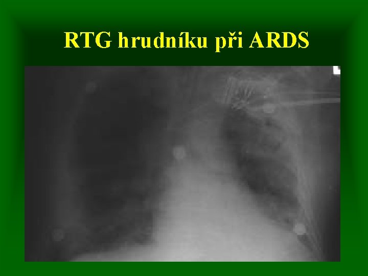 RTG hrudníku při ARDS 