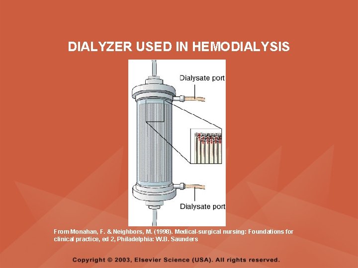 DIALYZER USED IN HEMODIALYSIS From Monahan, F. & Neighbors, M. (1998). Medical-surgical nursing: Foundations