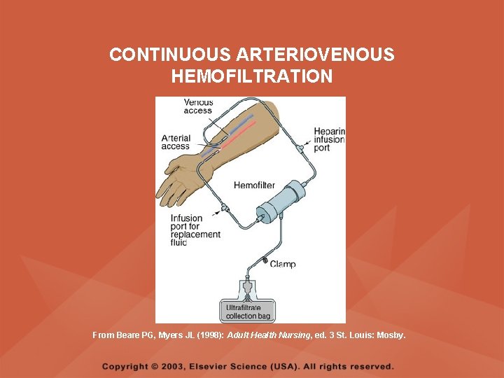 CONTINUOUS ARTERIOVENOUS HEMOFILTRATION From Beare PG, Myers JL (1998): Adult Health Nursing, ed. 3