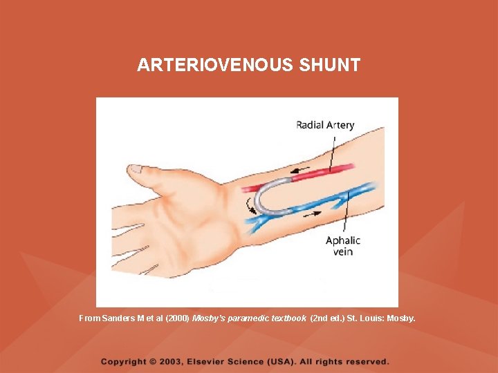 ARTERIOVENOUS SHUNT From Sanders M et al (2000) Mosby’s paramedic textbook (2 nd ed.