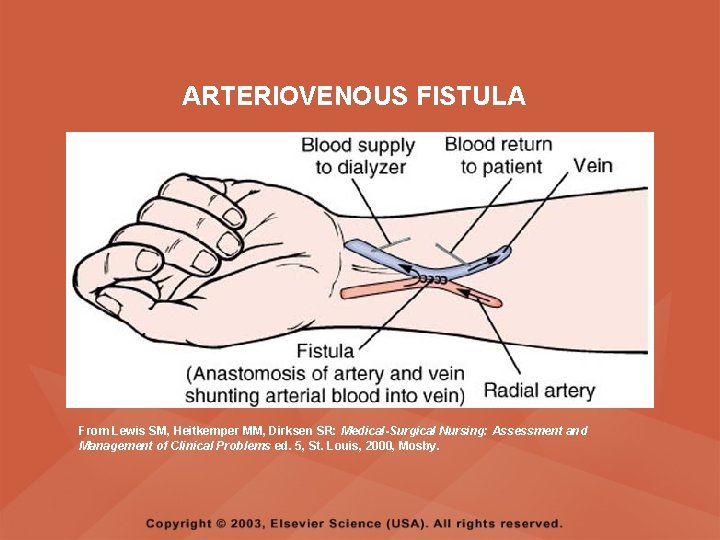 ARTERIOVENOUS FISTULA From Lewis SM, Heitkemper MM, Dirksen SR: Medical-Surgical Nursing: Assessment and Management