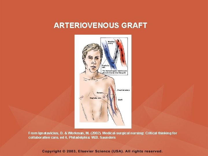ARTERIOVENOUS GRAFT From Ignatavicius, D. & Workman, M. (2002). Medical-surgical nursing: Critical thinking for