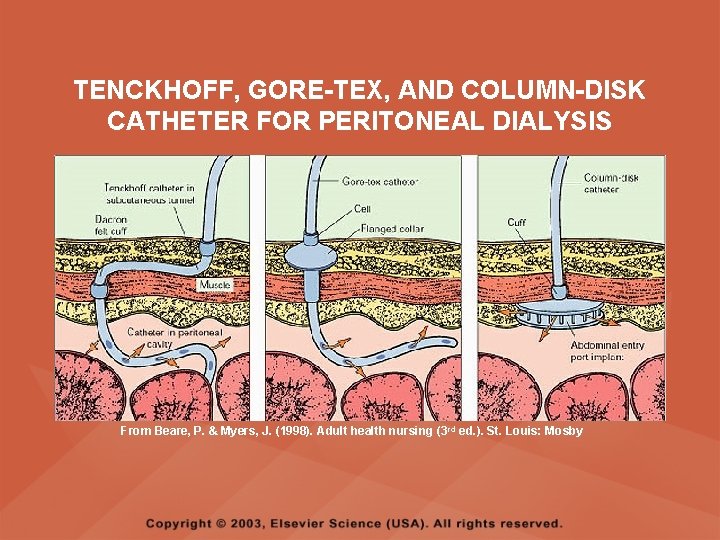 TENCKHOFF, GORE-TEX, AND COLUMN-DISK CATHETER FOR PERITONEAL DIALYSIS From Beare, P. & Myers, J.