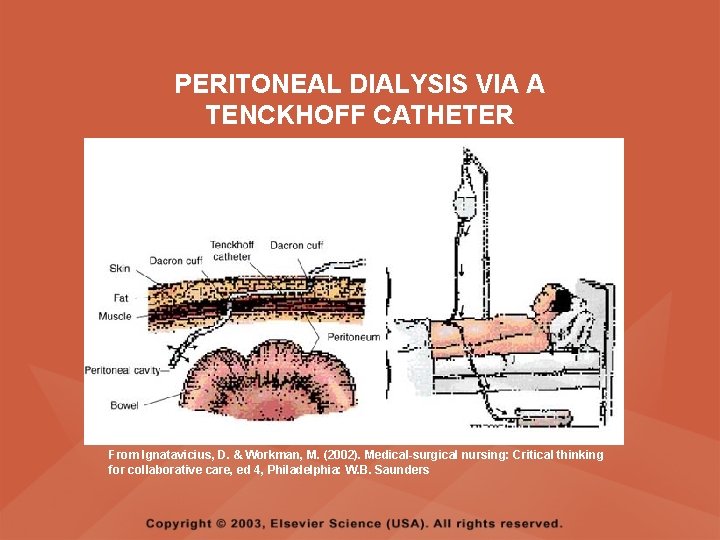 PERITONEAL DIALYSIS VIA A TENCKHOFF CATHETER From Ignatavicius, D. & Workman, M. (2002). Medical-surgical