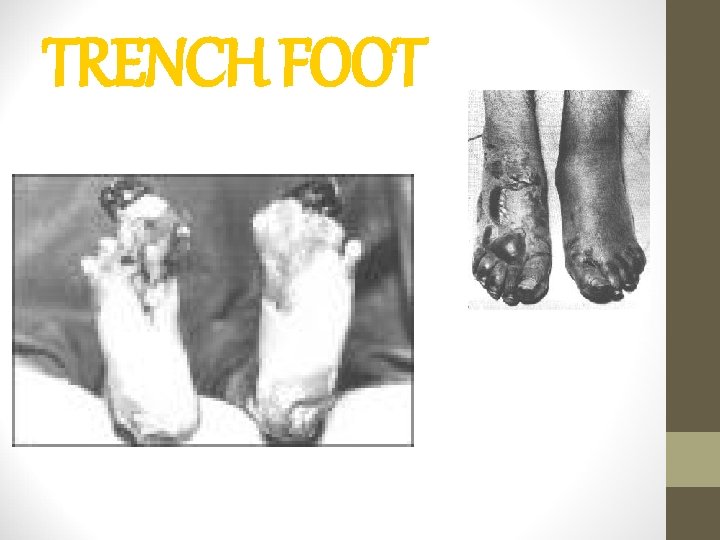 TRENCH FOOT 