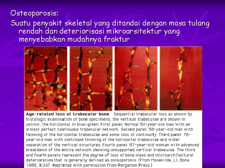 Osteoporosis: Suatu penyakit skeletal yang ditandai dengan masa tulang rendah dan deteriorisasi mikroarsitektur yang