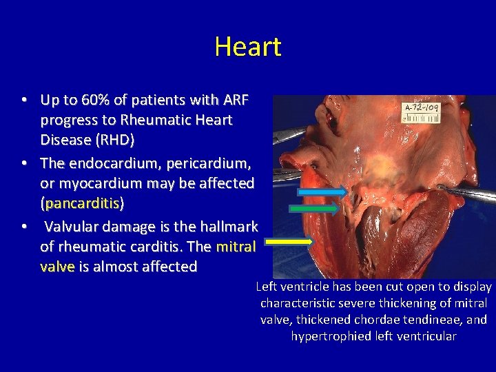 Heart • Up to 60% of patients with ARF progress to Rheumatic Heart Disease