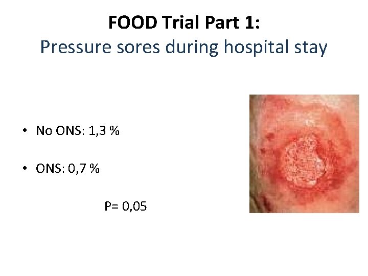 FOOD Trial Part 1: Pressure sores during hospital stay • No ONS: 1, 3