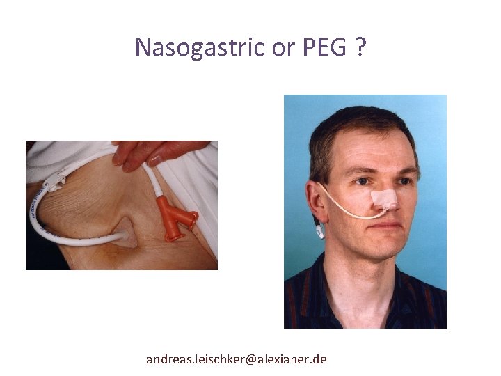 Nasogastric or PEG ? andreas. leischker@alexianer. de 