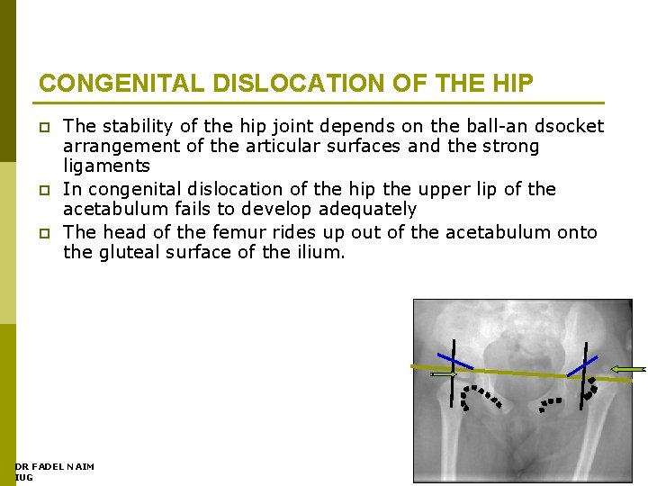 CONGENITAL DISLOCATION OF THE HIP p p p The stability of the hip joint