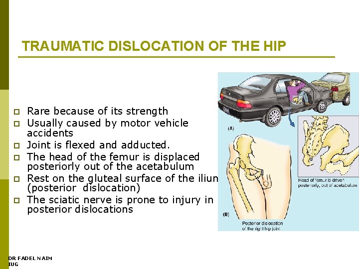 TRAUMATIC DISLOCATION OF THE HIP p p p Rare because of its strength Usually