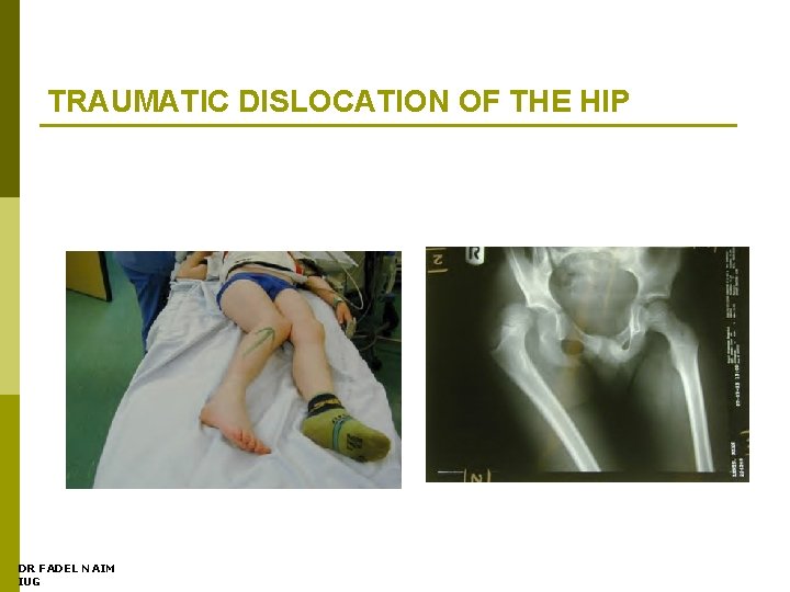 TRAUMATIC DISLOCATION OF THE HIP DR FADEL NAIM IUG 