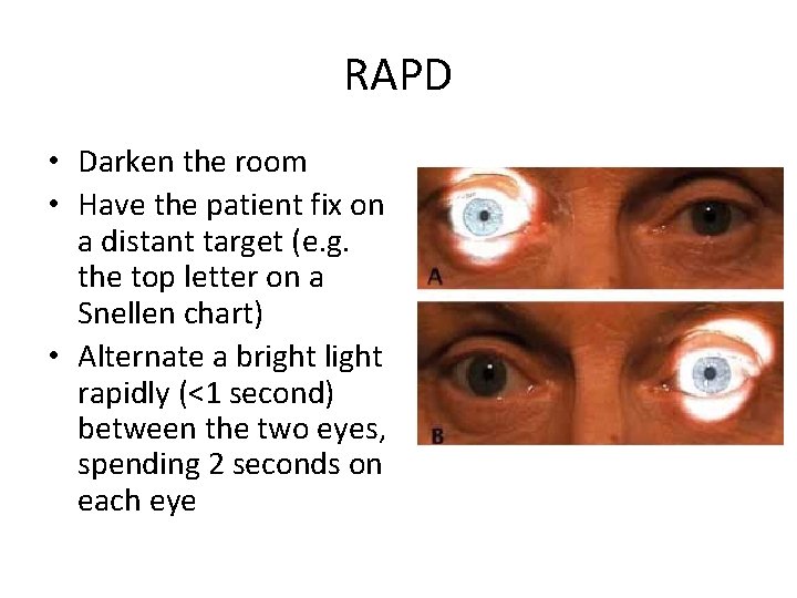 RAPD • Darken the room • Have the patient fix on a distant target