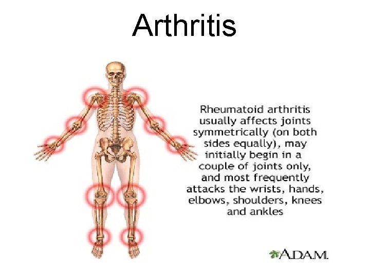Arthritis 