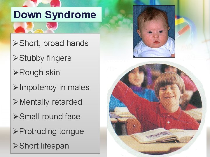 Down Syndrome ØShort, broad hands ØStubby fingers ØRough skin ØImpotency in males ØMentally retarded