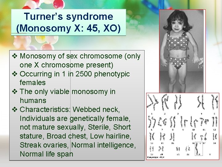 Turner’s syndrome (Monosomy X: 45, XO) v Monosomy of sex chromosome (only one X