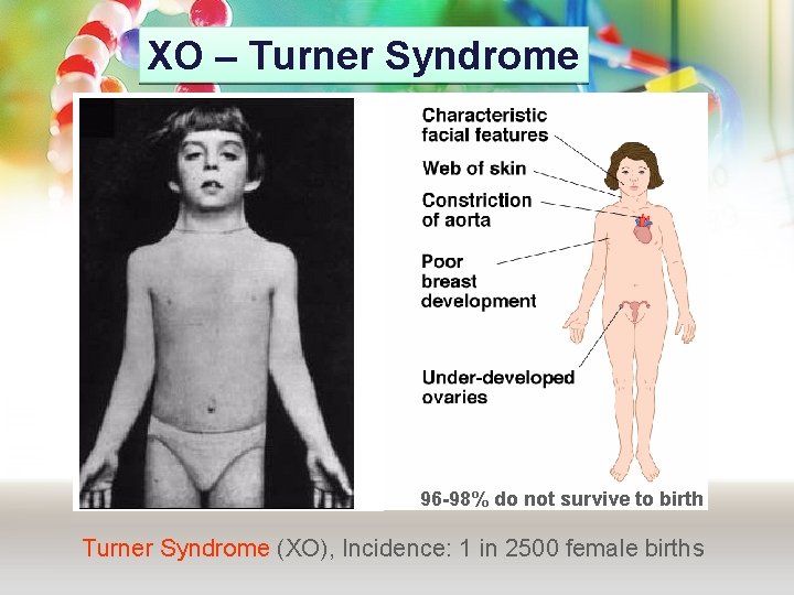 XO – Turner Syndrome 96 -98% do not survive to birth Turner Syndrome (XO),