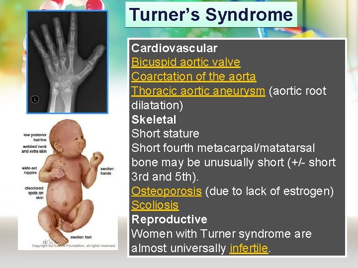 Turner’s Syndrome Cardiovascular Bicuspid aortic valve Coarctation of the aorta Thoracic aortic aneurysm (aortic