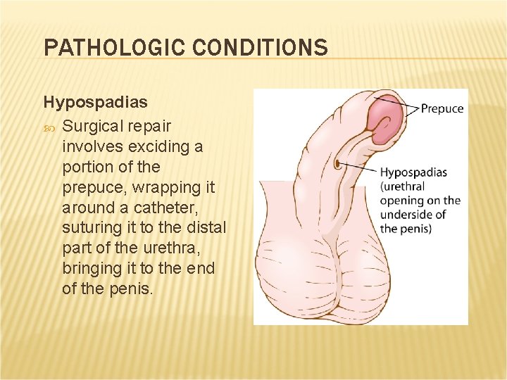 PATHOLOGIC CONDITIONS Hypospadias Surgical repair involves exciding a portion of the prepuce, wrapping it PATHOLOGIC CONDITIONS Hypospadias Surgical repair involves exciding a portion of the prepuce, wrapping it