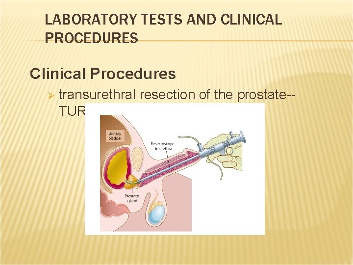 LABORATORY TESTS AND CLINICAL PROCEDURES Clinical Procedures Ø transurethral resection of the prostate-TURP LABORATORY TESTS AND CLINICAL PROCEDURES Clinical Procedures Ø transurethral resection of the prostate-TURP