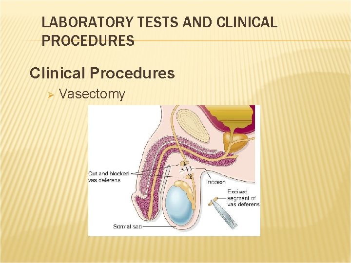 LABORATORY TESTS AND CLINICAL PROCEDURES Clinical Procedures Ø Vasectomy LABORATORY TESTS AND CLINICAL PROCEDURES Clinical Procedures Ø Vasectomy
