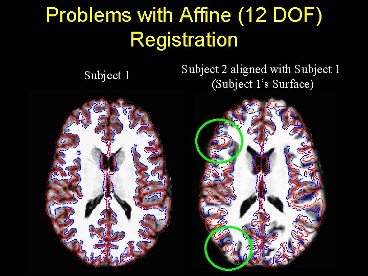 Problems with Affine (12 DOF) Registration Subject 1 Subject 2 aligned with Subject 1