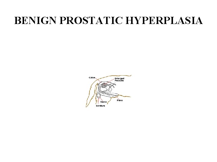 BENIGN PROSTATIC HYPERPLASIA 